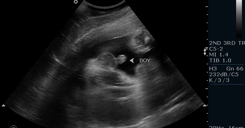 Boy Seen On Ultrasound!
