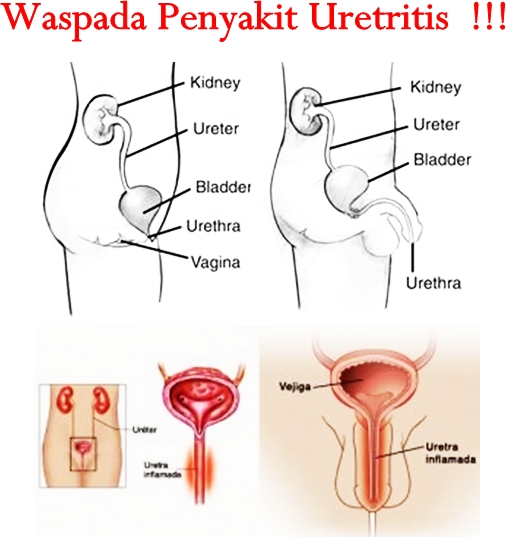 Obat Tradisional Uretritis