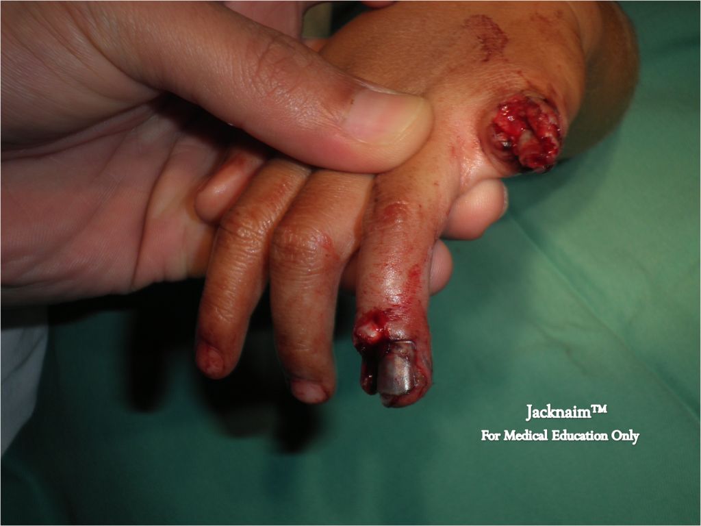 Phalanx Finger