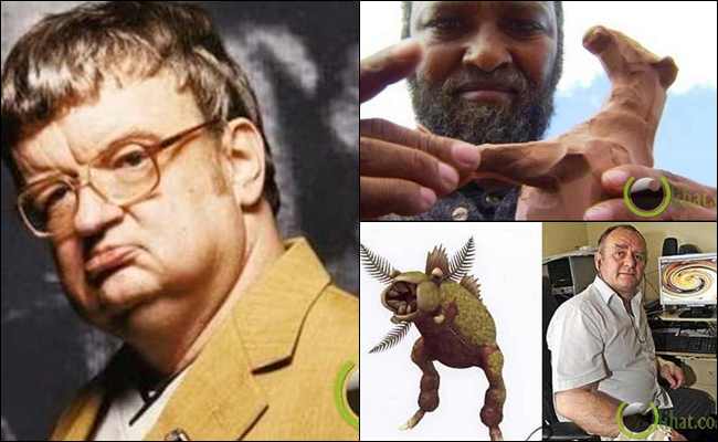 10 Orang ini Menjadi Luar Biasa setelah Otaknya di Operasi 10 Orang ini Menjadi Luar Biasa setelah Otaknya di Operasi