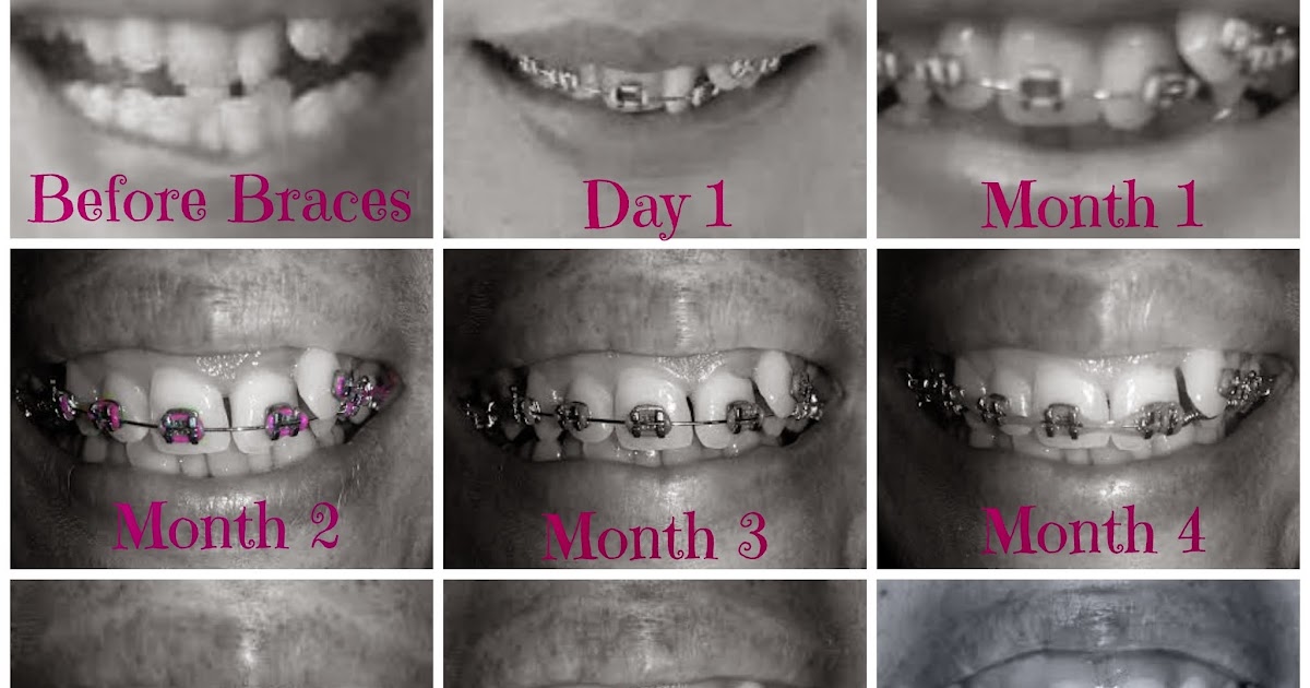 Adult Braces My Journey 7th Months with Braces & 5th Adjustment!