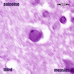 vol. 3: Measles