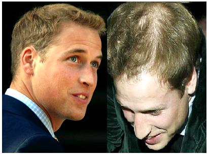 How To Solve Hair Loss In Young Men Problem Hair Loss In Young