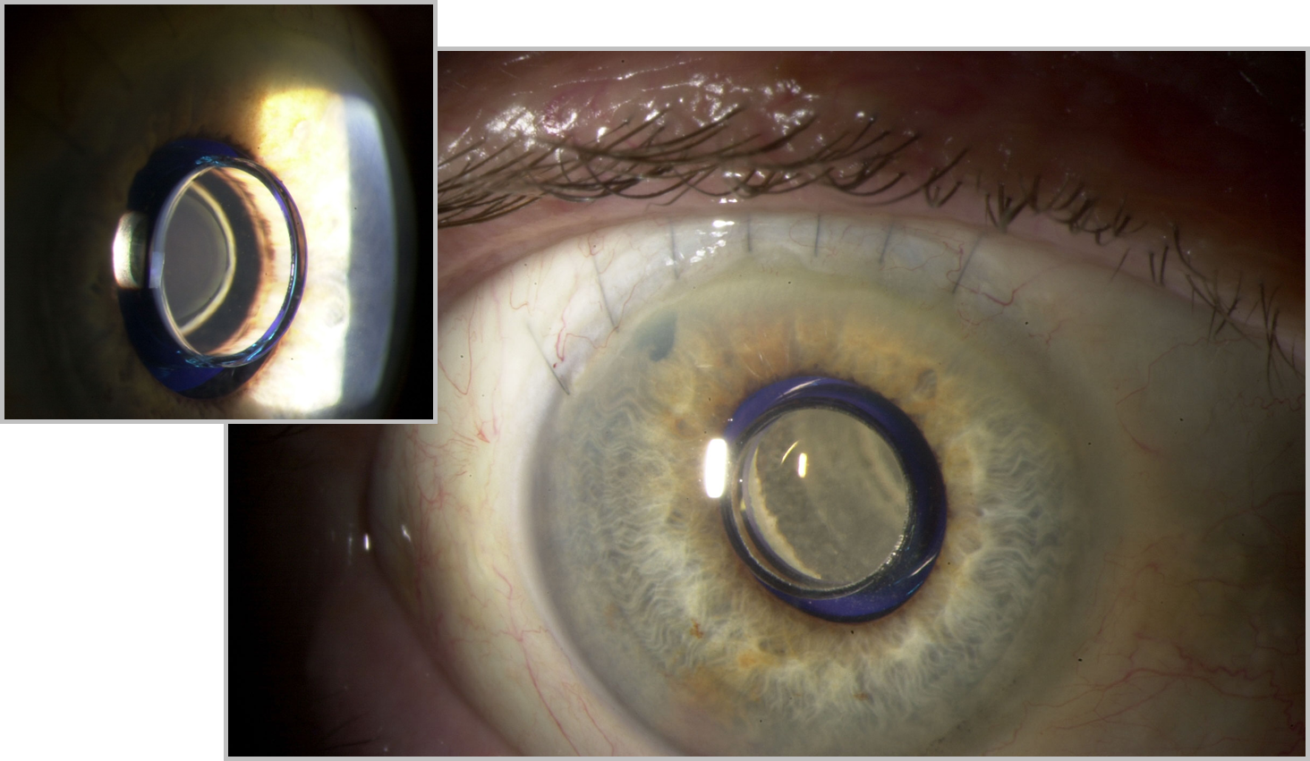 Telescope Implant for Macular Degeneration Vision Dynamics