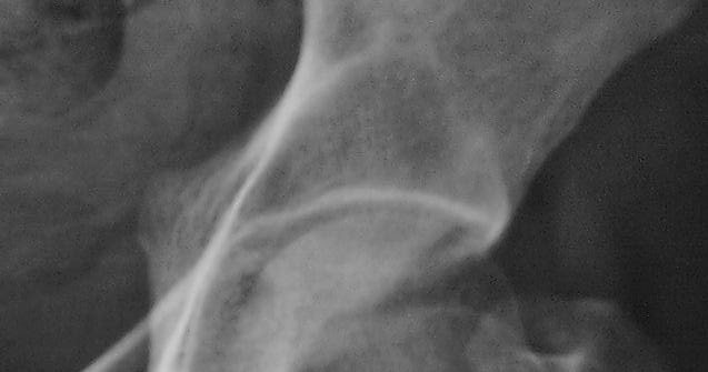 mricases: Large Sessile Osteochondroma Of The Lesser Trochanter Of