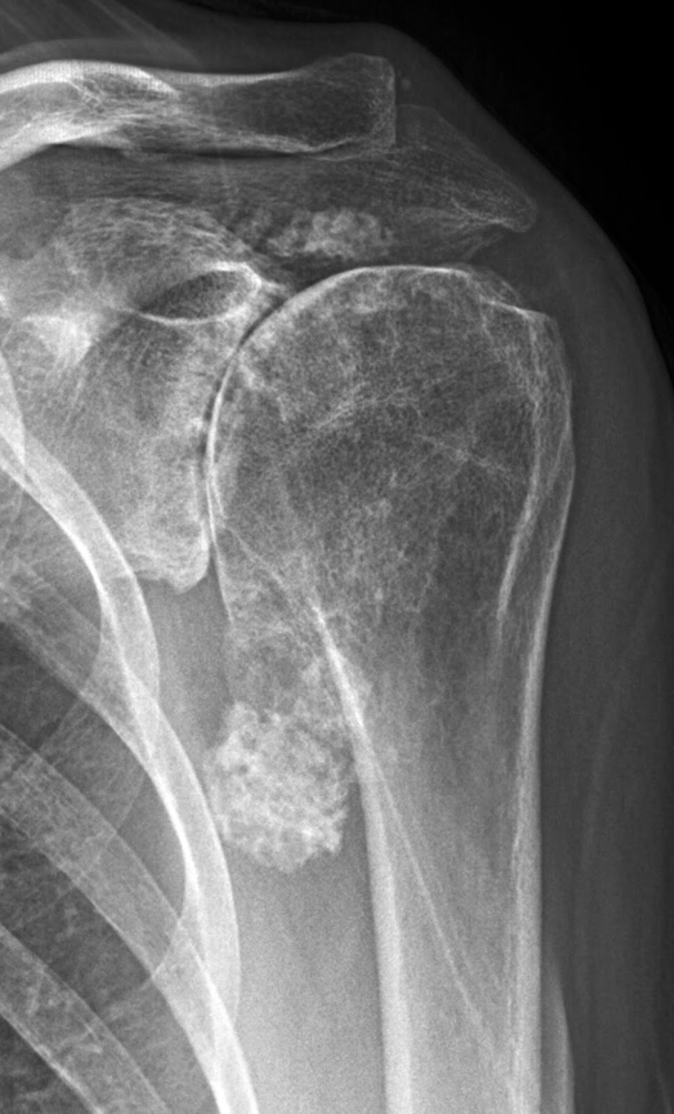 Shoulder Arthritis / Rotator Cuff Tears causes of shoulder pain