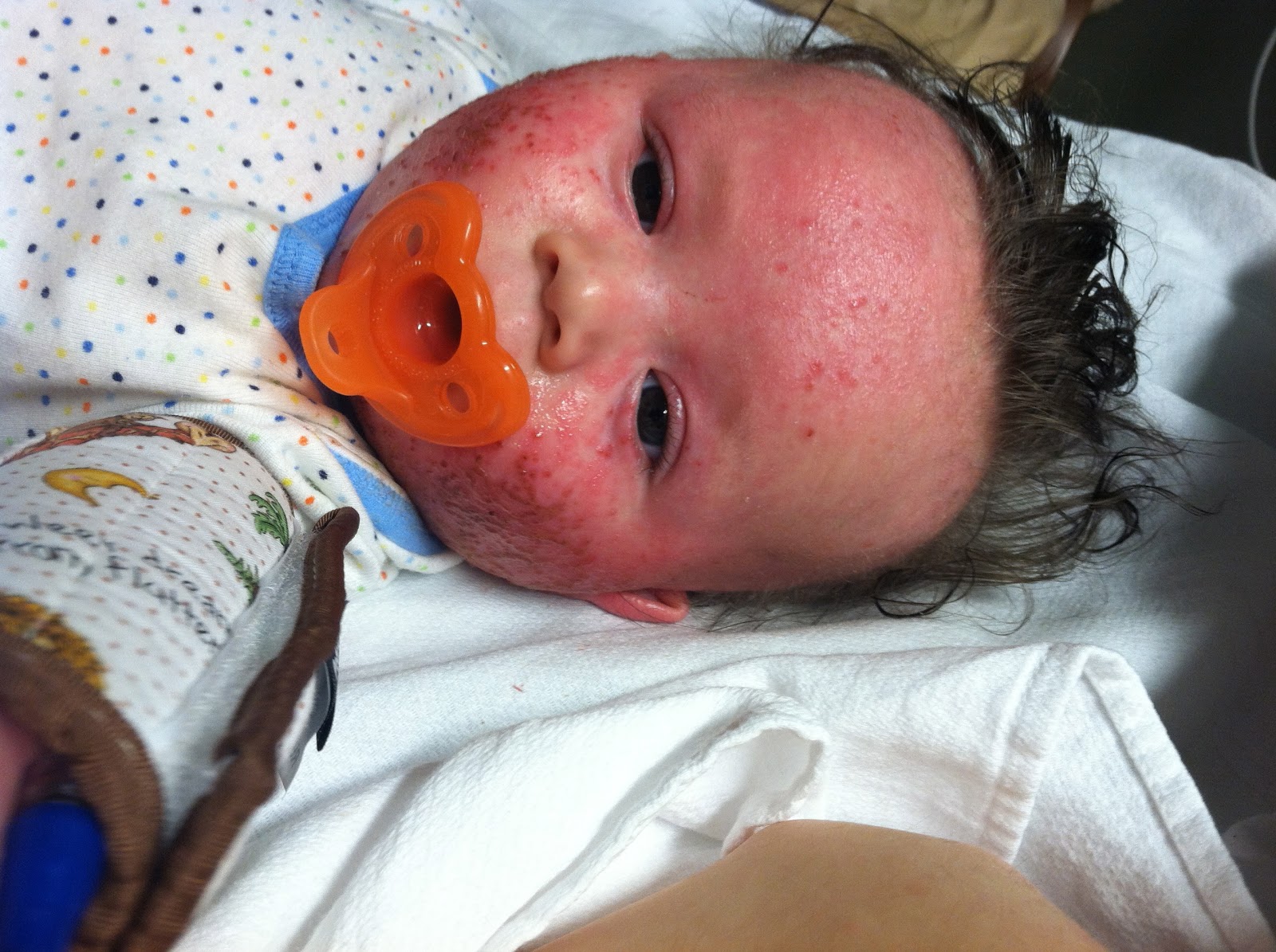 Momma Mom Eczema Story with pictures