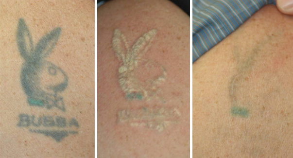 Does Laser Tattoo Removal Hurt