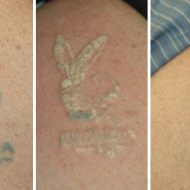 tattoo removal