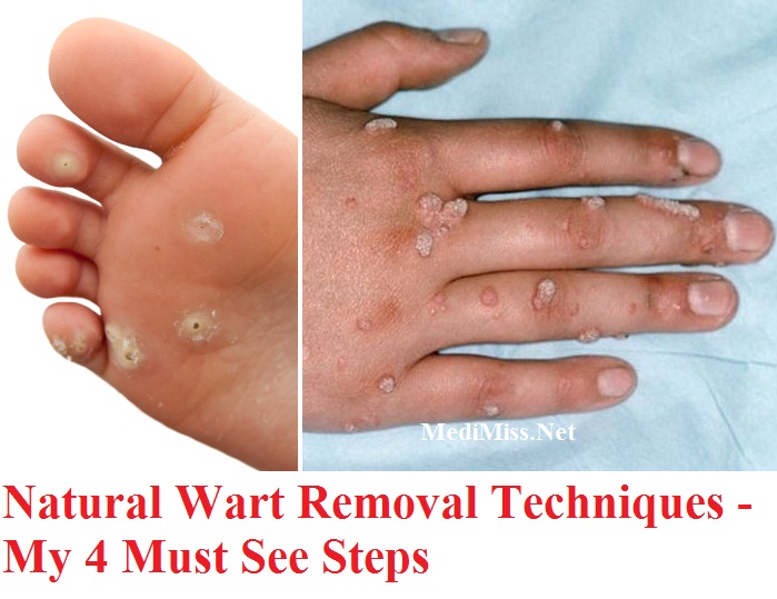 Remove Warts Permanently Most Effective Wart Treatment Healthy