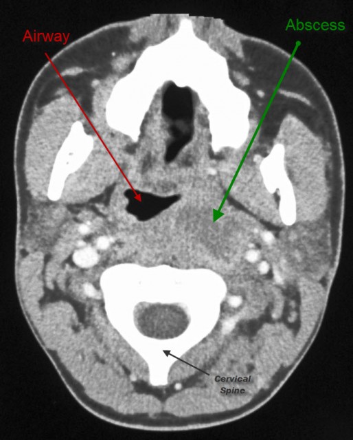 Image result for retropharyngeal abscess CT