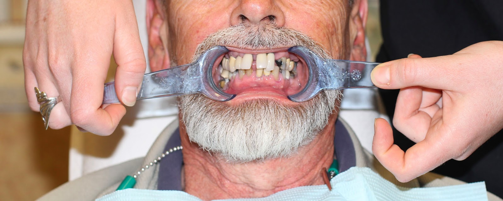 Golpa Dental Implant Center of Las Vegas G4 Implant Solution Dental Implants Las Vegas March