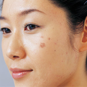 BÍ QUYẾT TRỊ NÁM DA TỪ RAU DIẾP CÁ CỰC HIỆU QUẢ BÍ QUYẾT TRỊ NÁM DA TỪ RAU DIẾP CÁ CỰC HIỆU QUẢ