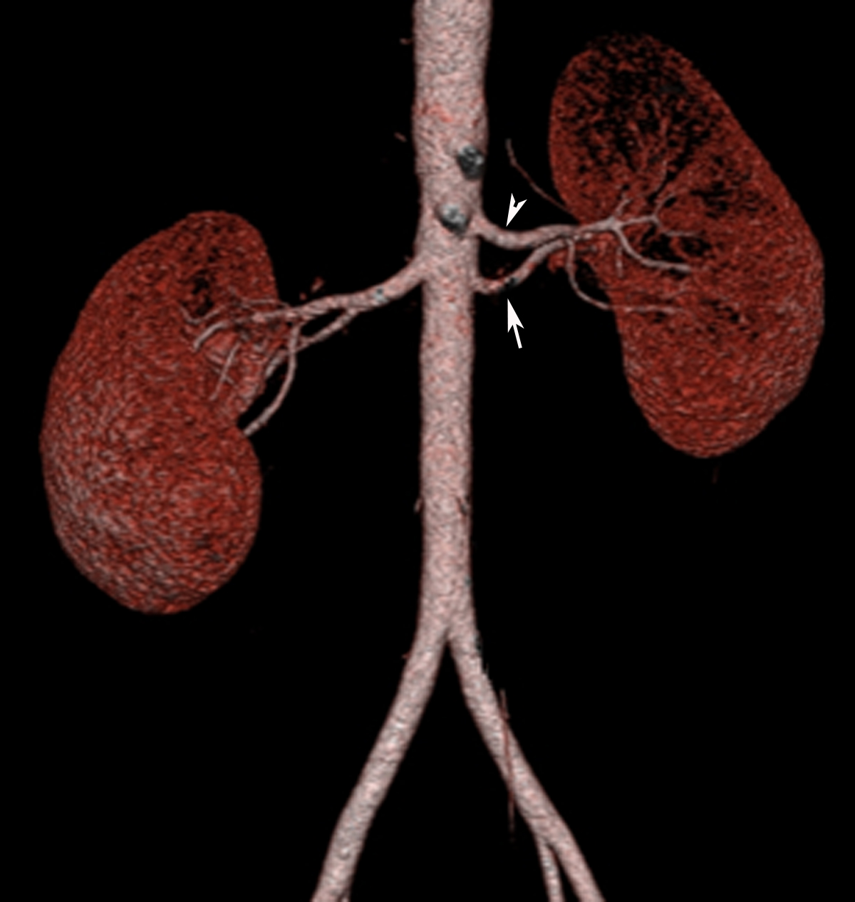 accessory renal artery