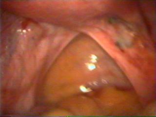 Endometriosis of uterosacral ligament diagnosed by laparoscopy- done by Dr. Alaa Mosbah