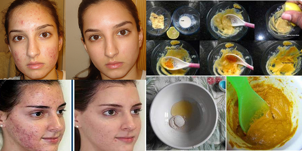 How To Get Rid Of Acne Fast At Home Remedies