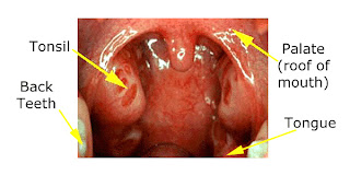 tonsils normal tonsil small mouth appearance abnormal adenoids kids inflamed side palate when throat tonsilitis soft if stones near left