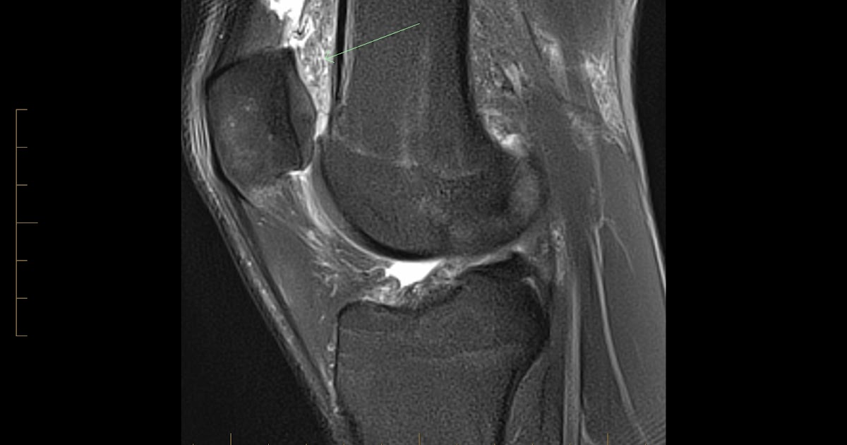 Radiology Cases Prefemoral Fat Pad Contusion from Direct Injury
