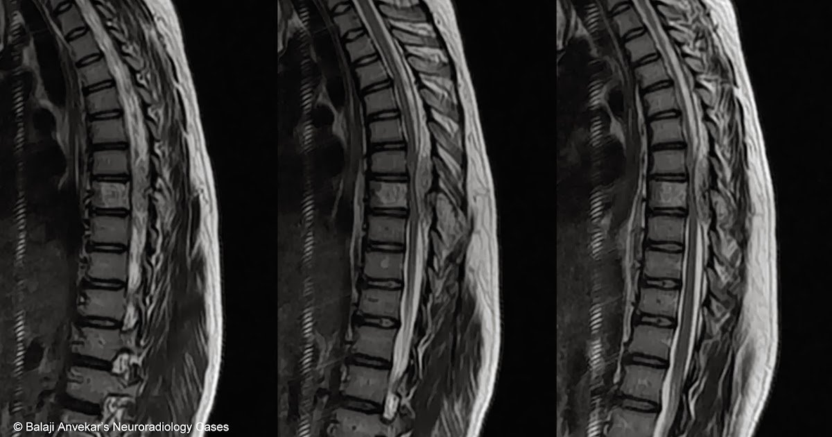 Dr Balaji Anvekar FRCR Spinal epidural lesion causing cord compression MRI