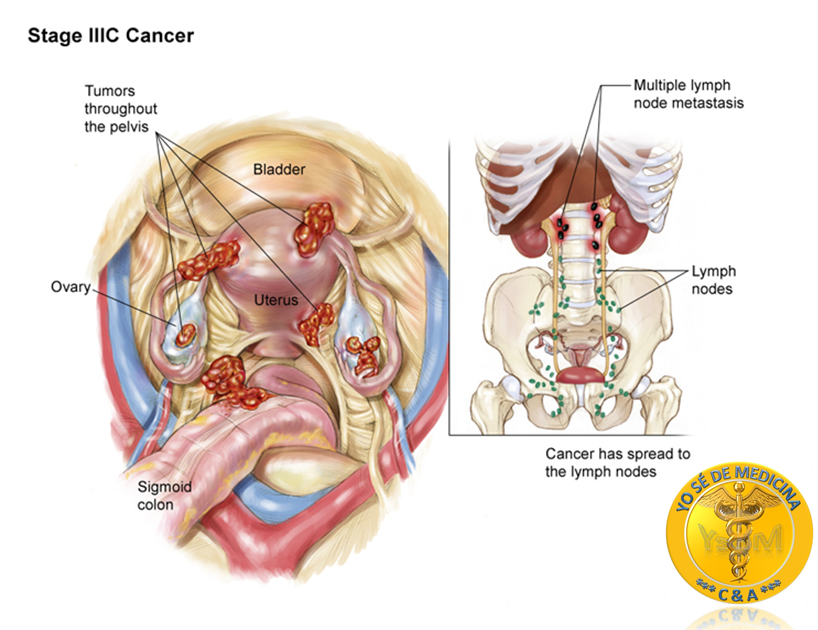 cervical cancer term paper The paper the pap smear test for cervical cancer describes that pap test is one of the oldest tests used in screening cervical cancers among women. cervical cancer term paper The paper the pap smear test for cervical cancer describes that pap test is one of the oldest tests used in screening cervical cancers among women.