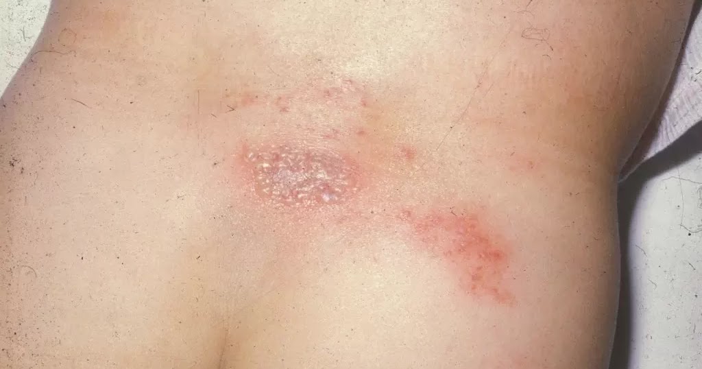 Penyakit Herpes Zoster dan Cara Pengobatan