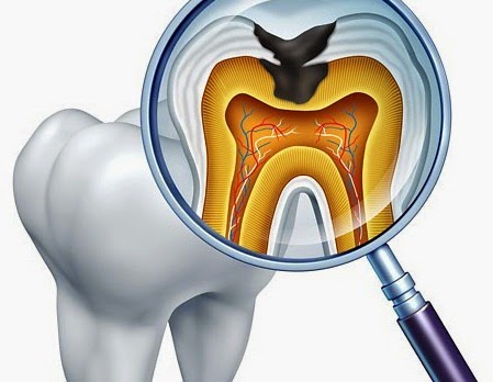 caries dentaires carie dentaire