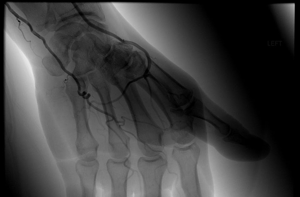 Interventional Radiology Casebook Hypothenar Hammer Syndrome