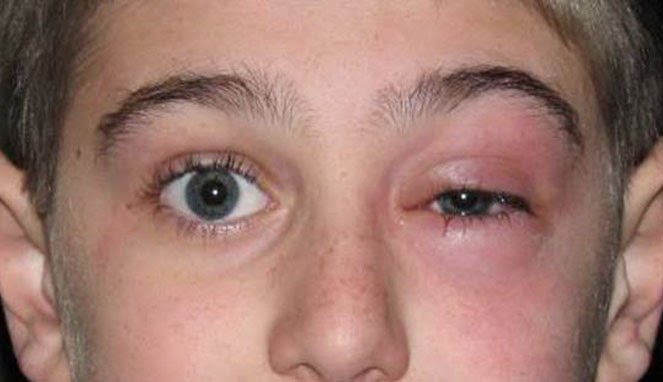 Cara Mengobati Mata Bintitan dengan Cepat