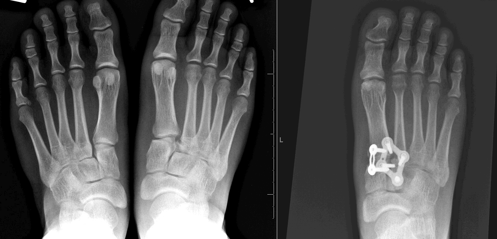 lisfranc fracture lisfranc fracture