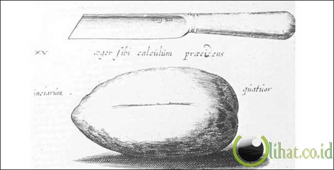Joannes Lethaeus,Born circa 1620...Operasi pengangkatan batu Kandung kemih seberat 4 ons Joannes Lethaeus,Born circa 1620...Operasi pengangkatan batu Kandung kemih seberat 4 ons