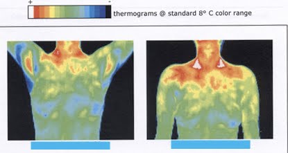 Permanent thermoregulatory dysfunction after ETS