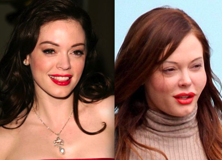 Rose McGowan Surgery - Celebrity Pictures