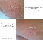 BROWN SPOTS REMOVAL