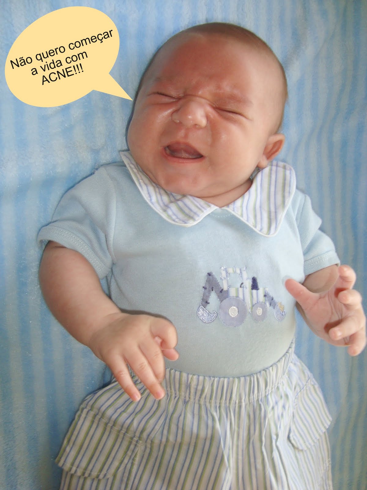 Acne Neonatal