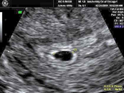 Hình ảnh bình thường siêu âm thai 3 tháng đầu