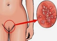 kutil di vagina menyembuhkan kutil di vagina