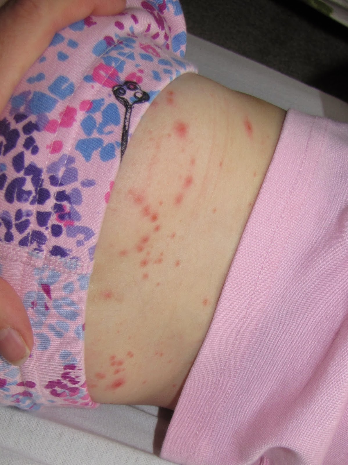 Hand, Foot, and Mouth Disease. Help me. — The Bump