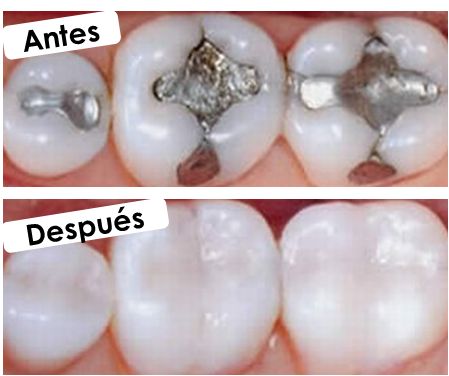 ODONTOESTETICA A TU ALCANCE: RESINAS COMPUESTAS. Caso Clínico