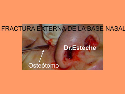 Rinoplastia cerrada | Part 15 | Dorso óseo | Osteotomía | Hueso nasal | facebok +nariz osteotomia Rinoplastia cerrada | Part 15 | Dorso óseo | Osteotomía | Hueso nasal |