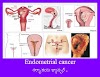 Uterine cancer, Endometrial cancer,గర్భాశయ క్యాన్సర్ , ఎండోమెట్రియల్ క్యాన్సర్ , యుటెరైన్‌ క్యాన్సర్