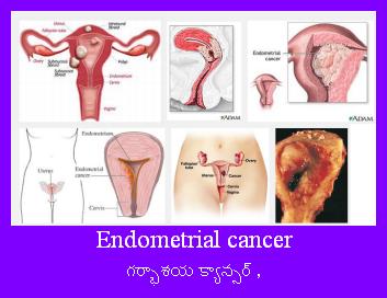 Uterine cancer, Endometrial cancer,గర్భాశయ క్యాన్సర్ , ఎండోమెట్రియల్ క్యాన్సర్ , యుటెరైన్‌ క్యాన్సర్