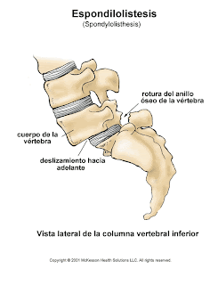 Spondylolisthesis spine EHLERS DANLOS "ENLACES"- Argentina : ESPONDILOLISTESIS