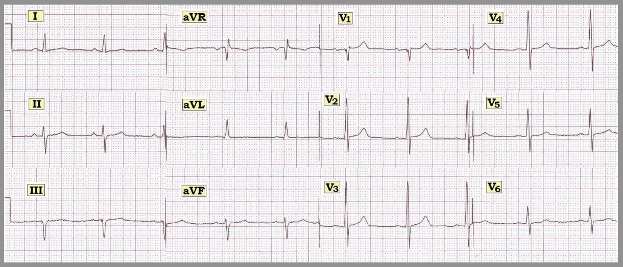 Ecg Interpretation Ecg Interpretation Review 29 Infarction Hemiblock Normal Q Waves