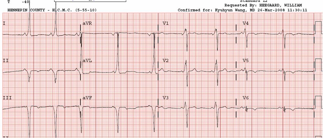 Ekg Acute Mi