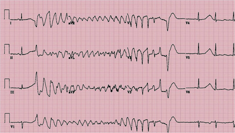 VENTRIKEL TACHICARDIA