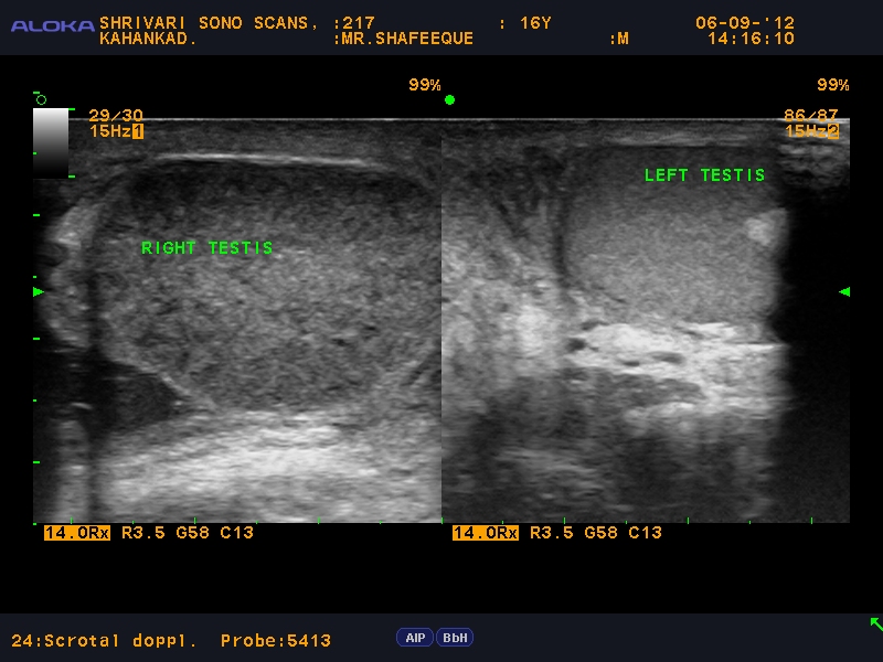 Shrivari Sono Scans Ultrasound images in acute scrotumTorsion Testis