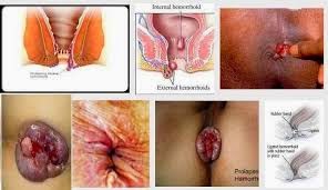 wasir obat herbal wasir