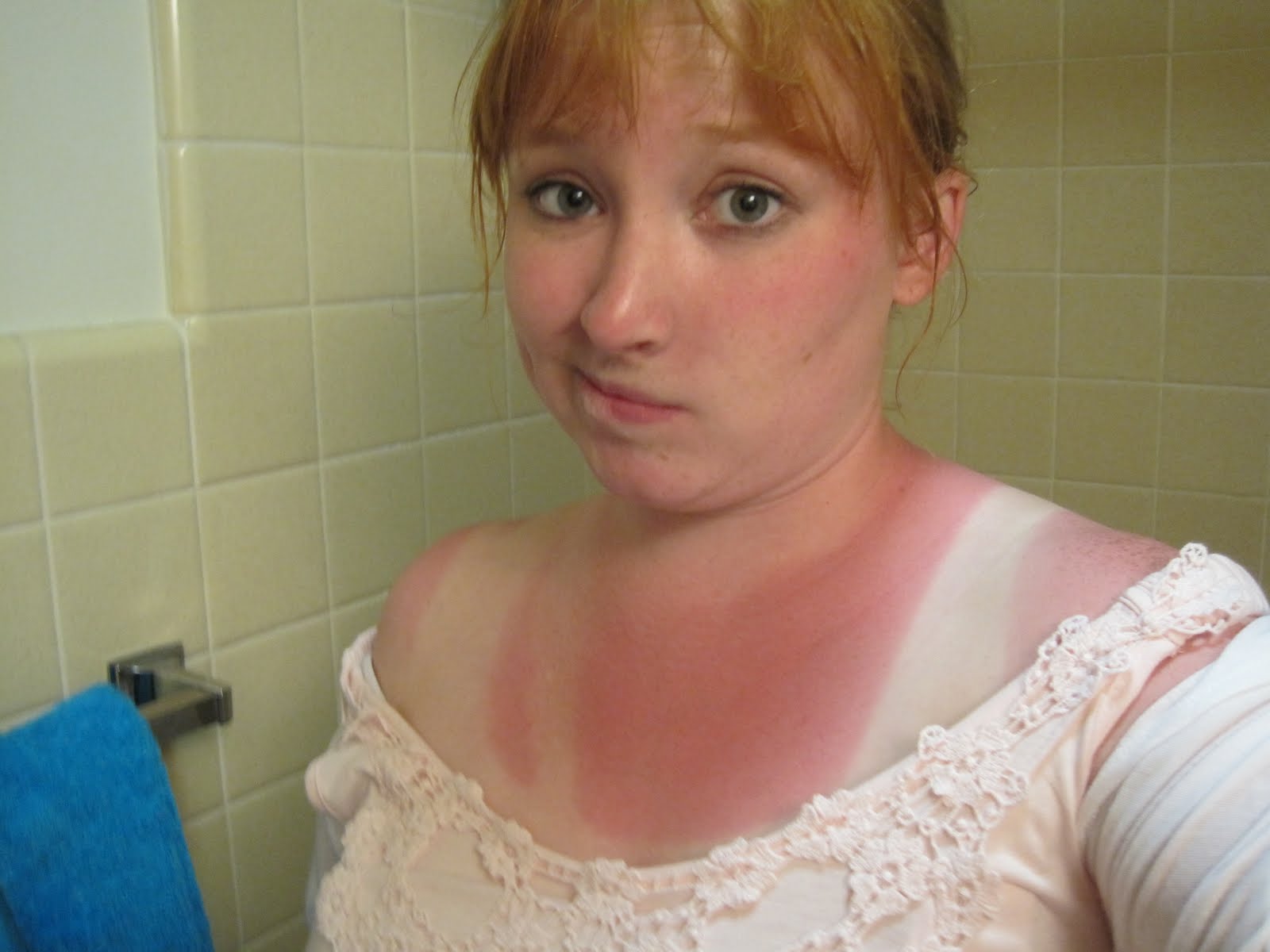 Ginger Sunburn