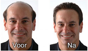 Hair Loss Alopecia Blog Hair Fall Guide A Burning Scalp With