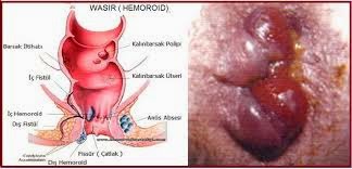 Ambein Atau Wasir Ambein Atau Wasir